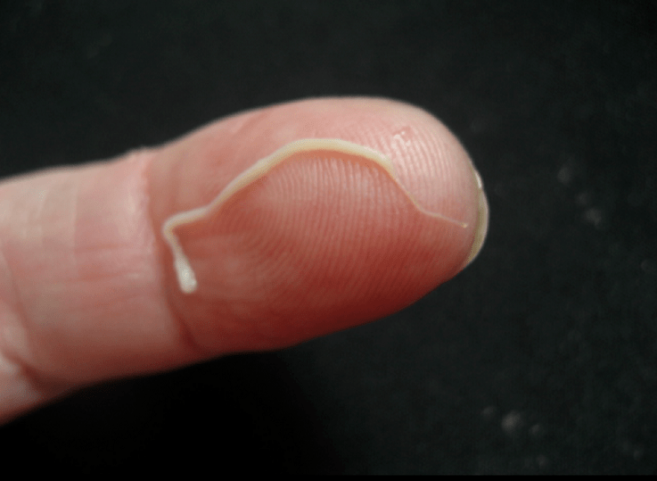 parasite nématode du corps humain